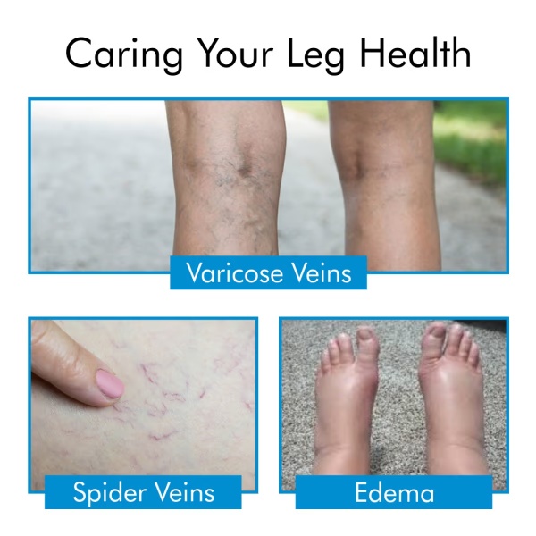3031-accusure-varicose-vein-stockings-l-1-s-1.jpg