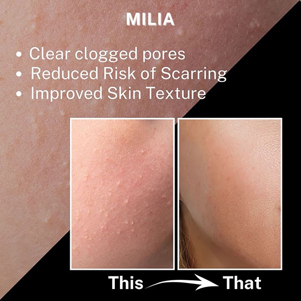 4986-house-of-beauty-milia-serum-for-white-cysts-black-amp-whiteheads-open-pores-with-azelaic-15ml-1.jpg