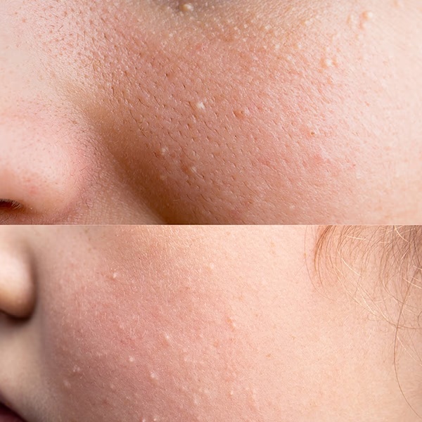 4986-house-of-beauty-milia-serum-for-white-cysts-black-amp-whiteheads-open-pores-with-azelaic-15ml-1.jpg